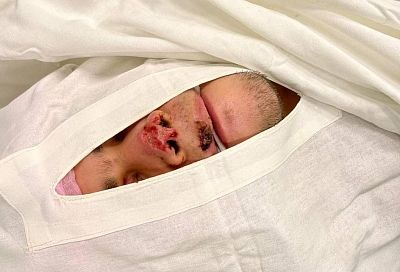 Краснодарские врачи восстановили мужчине откушенный в драке нос 